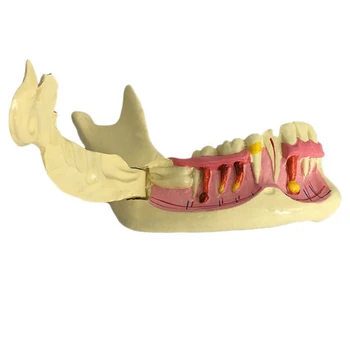 Модель эндодонтического лечения, анатомия десен, изучение зубов, модель патологии для взрослых